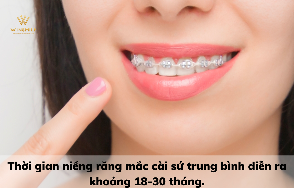 Niềng răng mắc cài tự động 3M có thể mất từ 18-30 tháng.