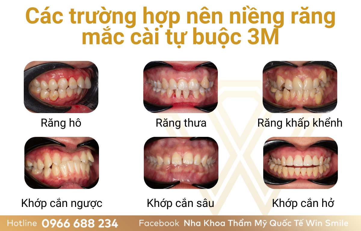 Các trường hợp nên niềng răng mắc cài tự buộc 3M