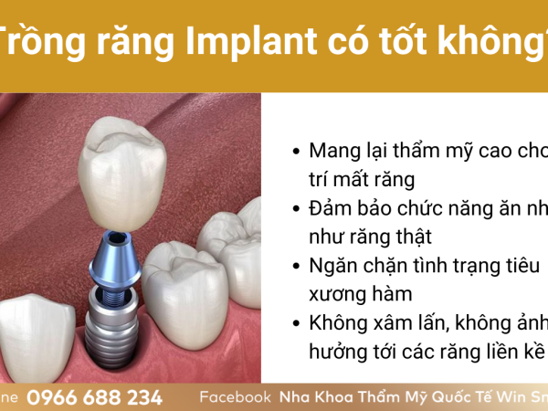 Tất tần tật những điều cần biết về kỹ thuật trồng răng Implant