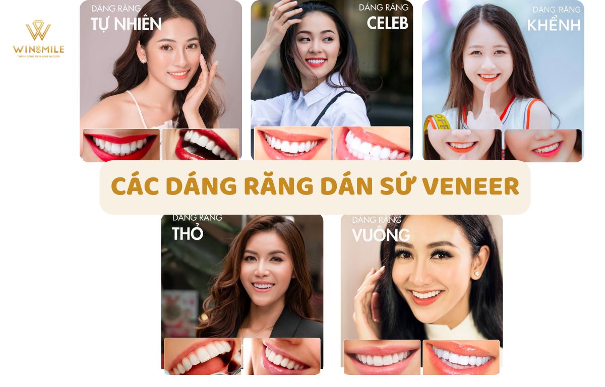 Các dáng răng dán sứ veneer được sử dụng phổ biến