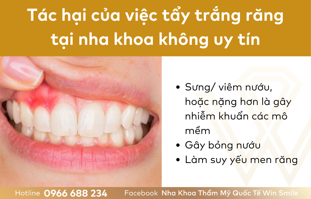 Tác hại của việc tẩy trắng răng tại nha khoa không uy tín