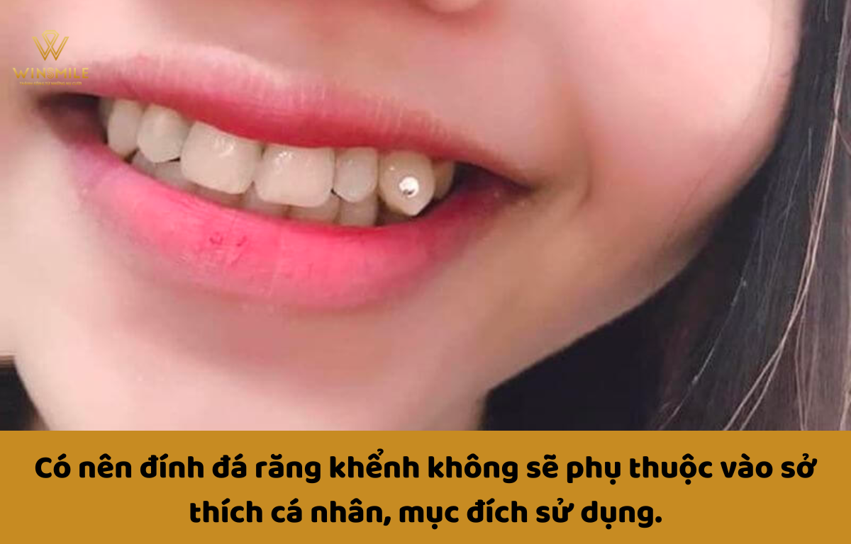 1. Định nghĩa và lợi ích của việc đính đá răng khểnh