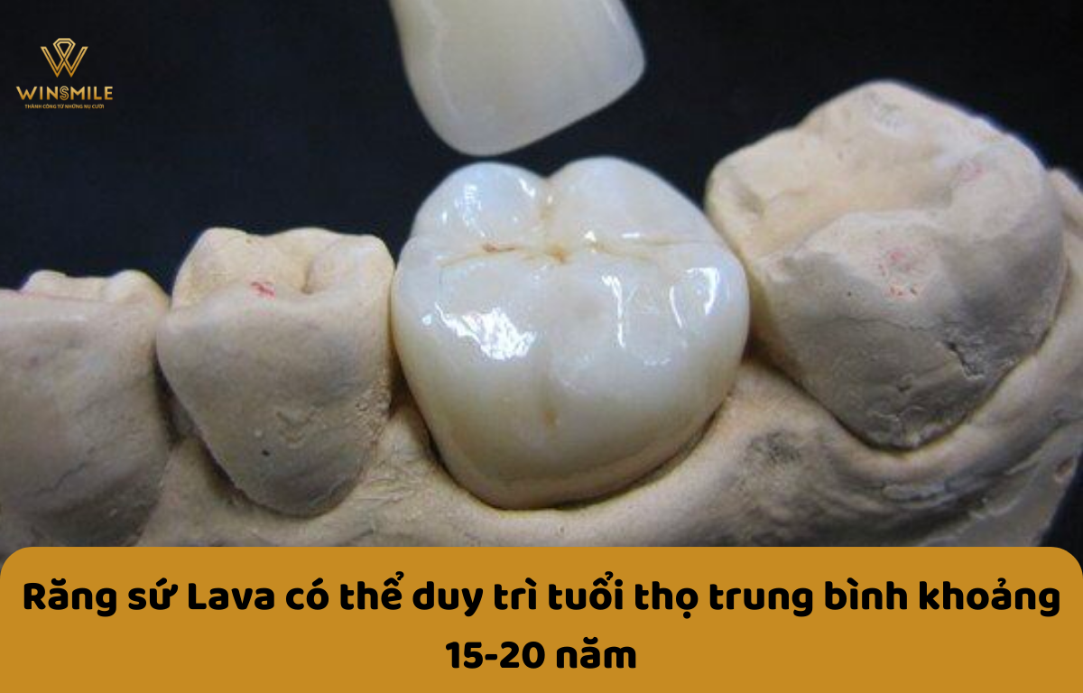 Tuổi thọ răng sứ Lava khoảng 15-20 năm.