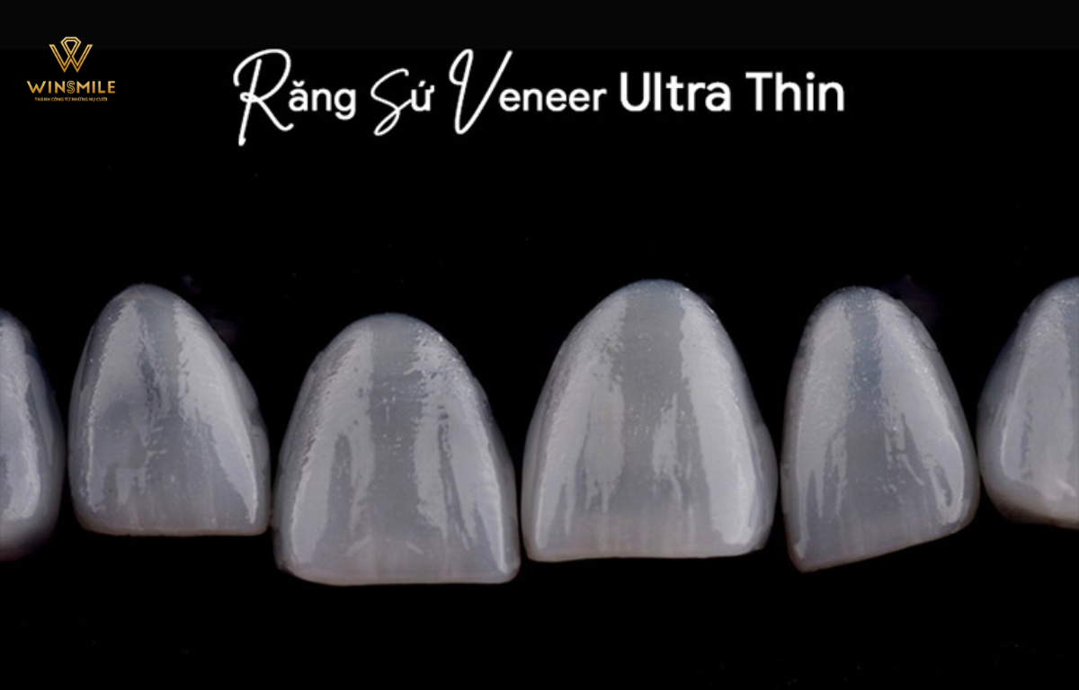 Mặt dán sứ veneer Ultrathin mỏng nhẹ, hạn chế mài răng