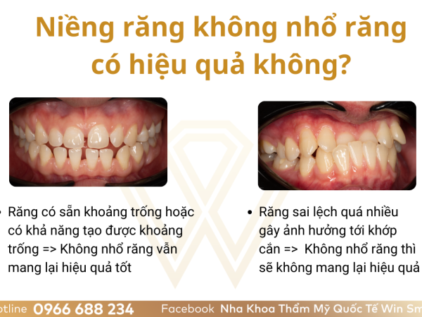 Niềng răng không nhổ răng có được không? Việc nhổ răng khi niềng răng có gây hại gì cho sức khỏe răng miệng sau này không?
