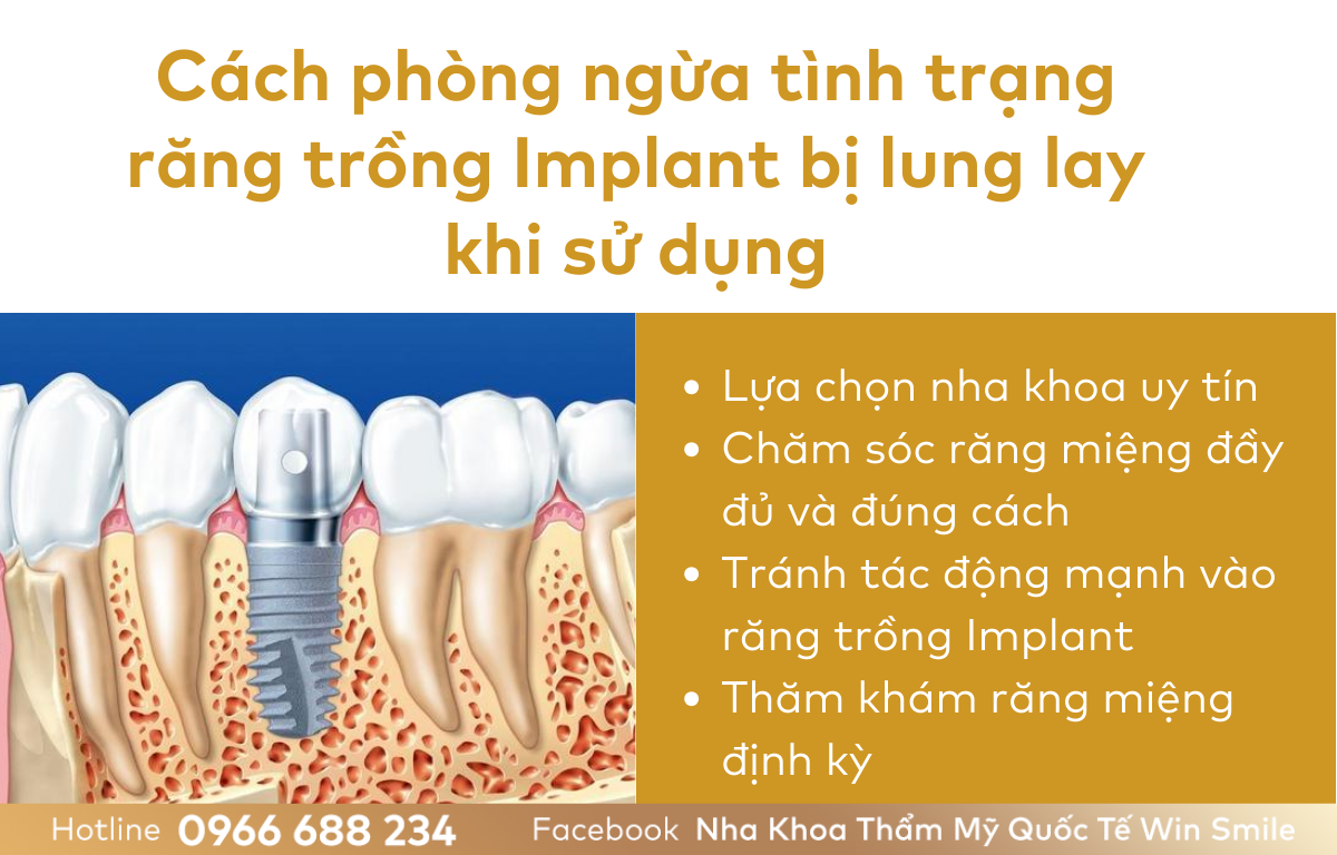Cách phòng ngừa tình trạng răng trồng Implant bị lung lay khi sử dụng