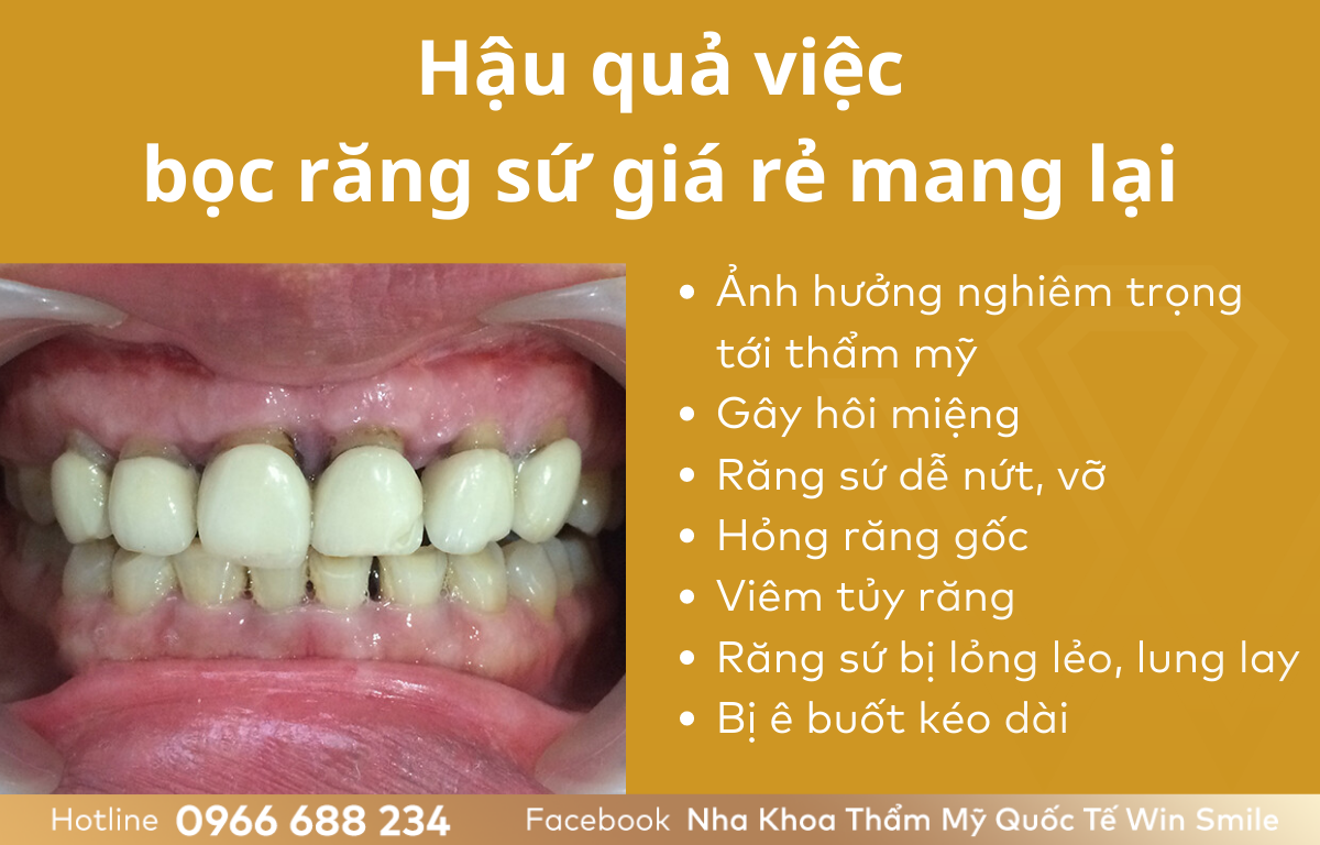 Giới thiệu về răng sứ giá rẻ