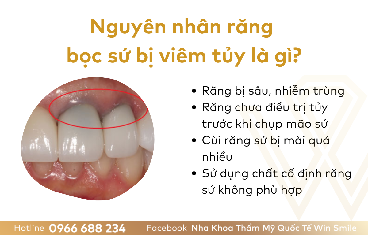 Răng Bọc Sứ Bị Viêm Tủy: Nguyên Nhân, Triệu Chứng và Cách Khắc Phục Hiệu Quả