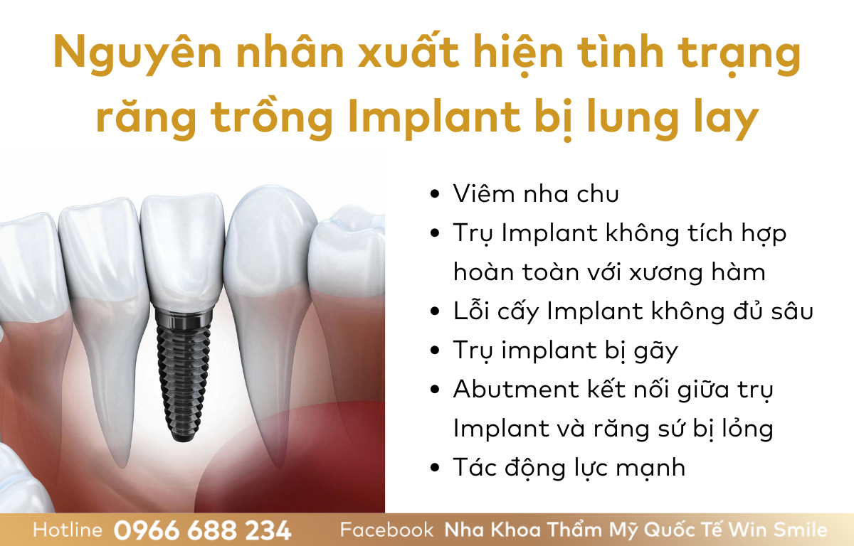 Nguyên nhân xuất hiện tình trạng răng trồng Implant bị lung lay