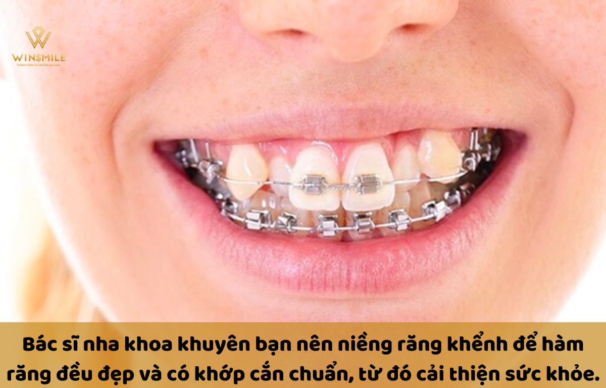 Niềng răng khểnh giúp sở hữu hàm răng đều đẹp.