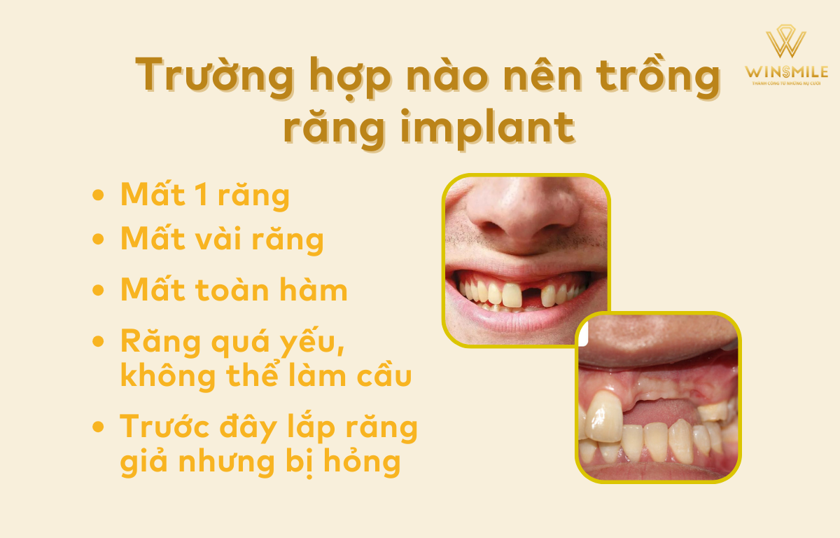 Trường hợp nào nên trồng răng implant