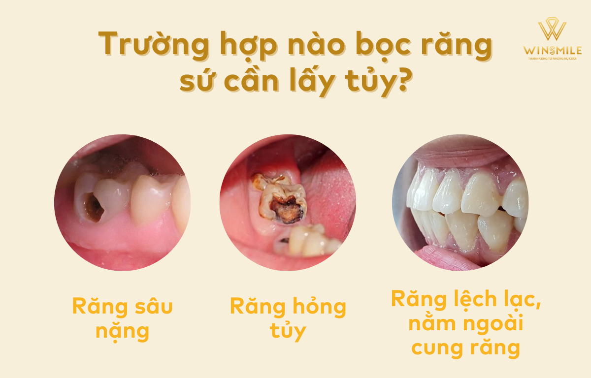 Ảnh Hưởng Của Việc Lấy Tủy Đối Với Răng Bọc Sứ