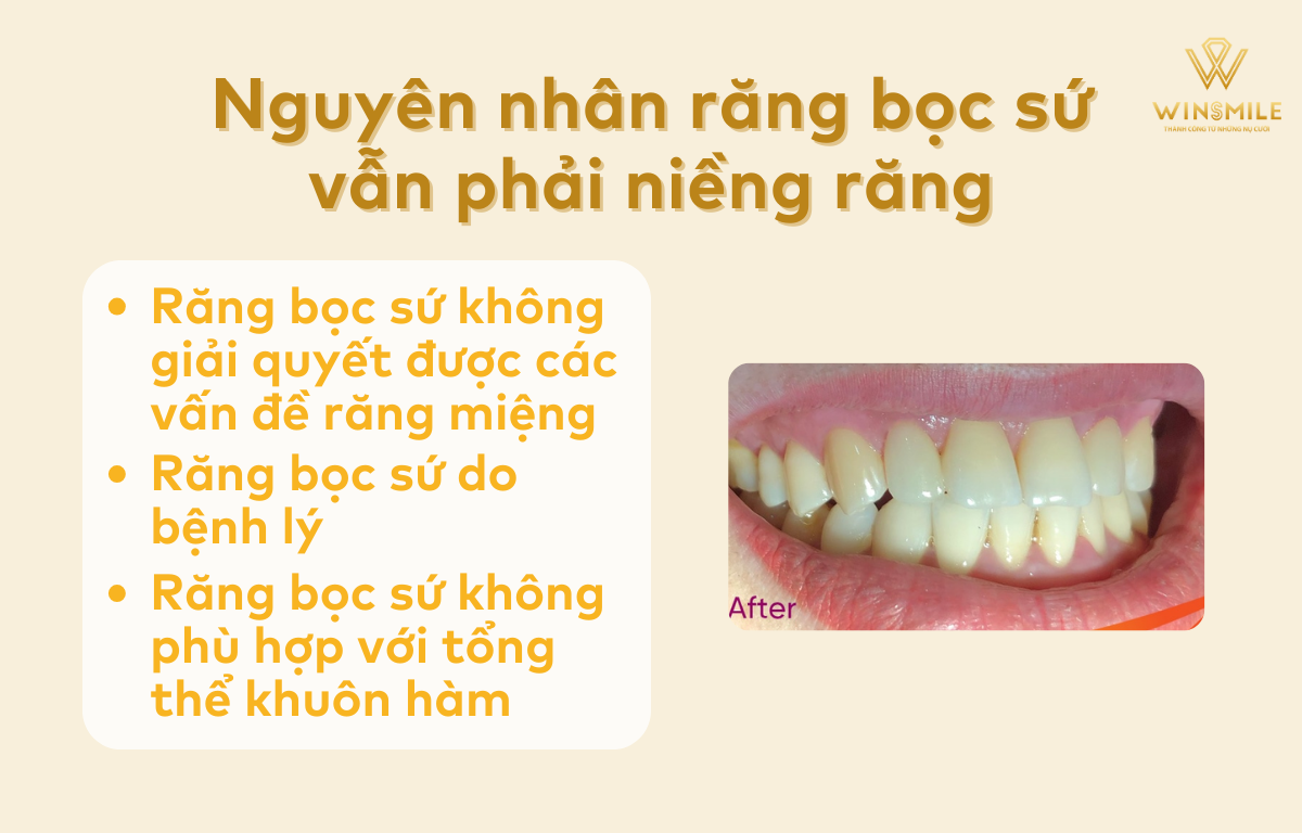 Nguyên nhân răng đã bọc sứ còn phải niềng răng
