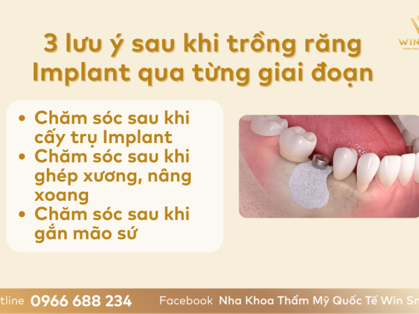 4 lưu ý sau khi trồng răng Implant từ chuyên gia