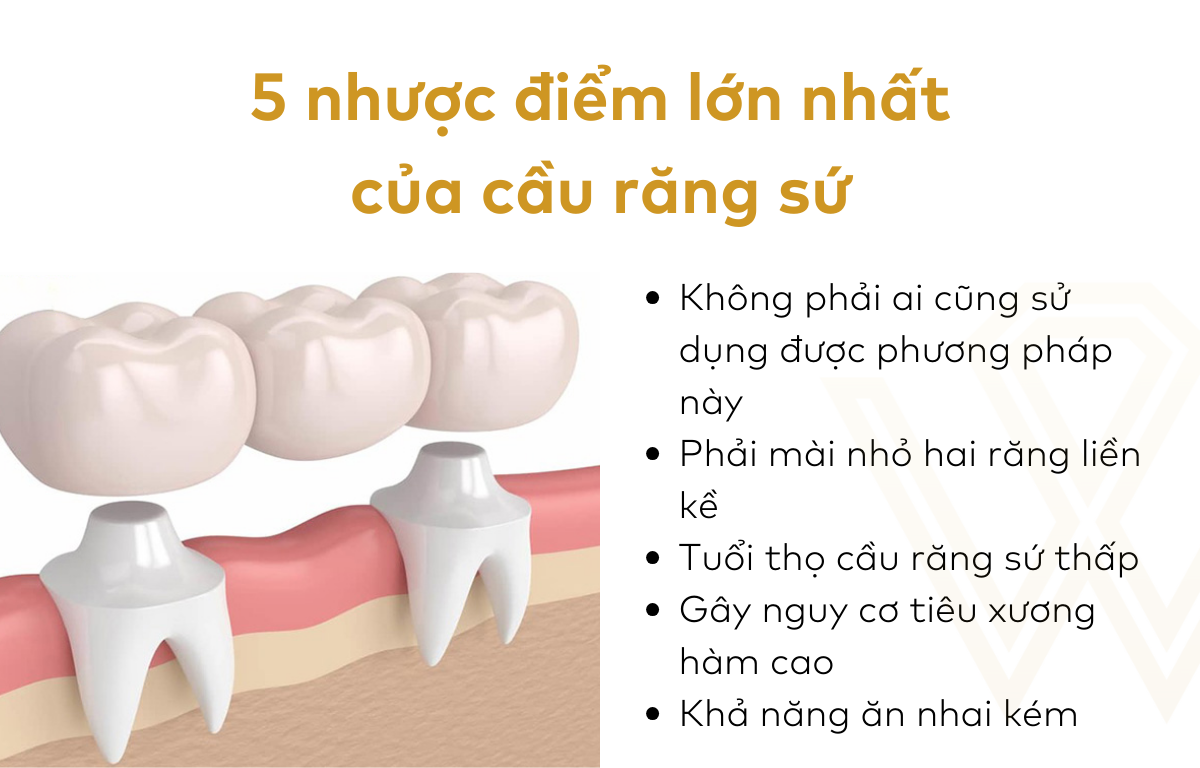 5 nhược điểm lớn nhất của cầu răng sứ