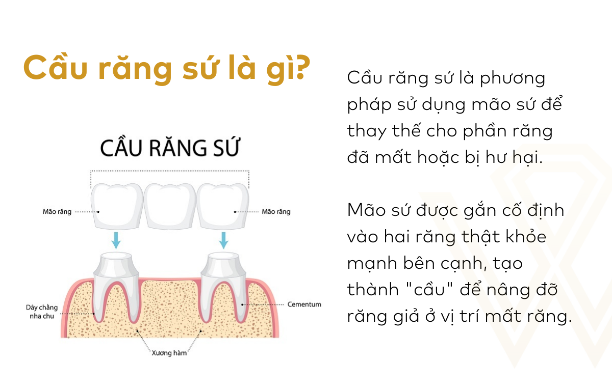 Cầu răng sứ là gì