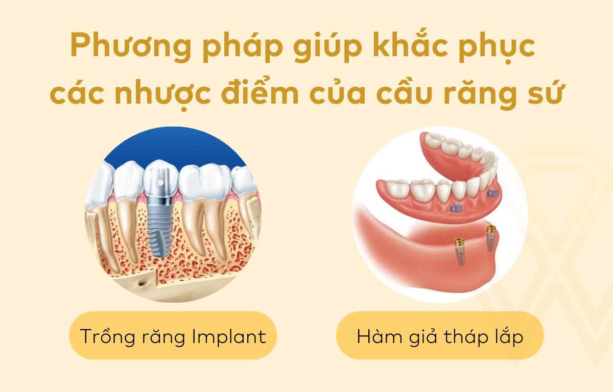 Phương pháp giúp khắc phục các nhược điểm của cầu răng sứ