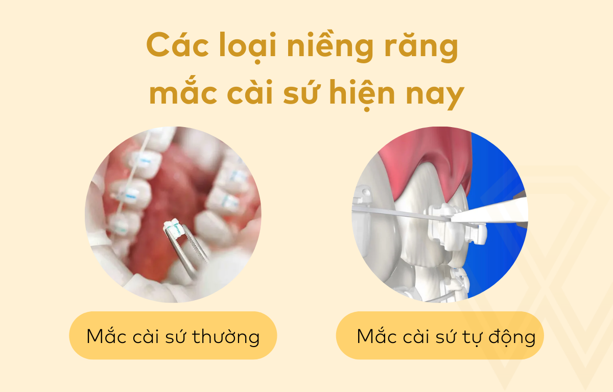 Các loại niềng răng mắc cài sứ hiện nay