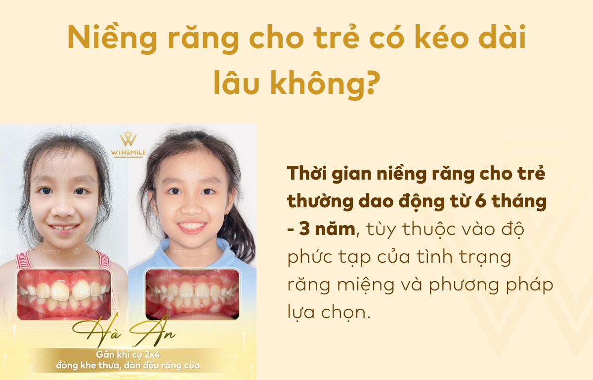 Niềng răng cho trẻ có kéo dài lâu không