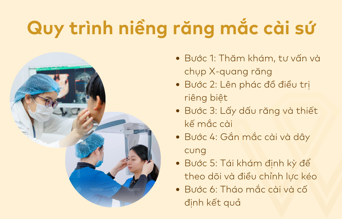 Quy trình niềng răng mắc cài sứ
