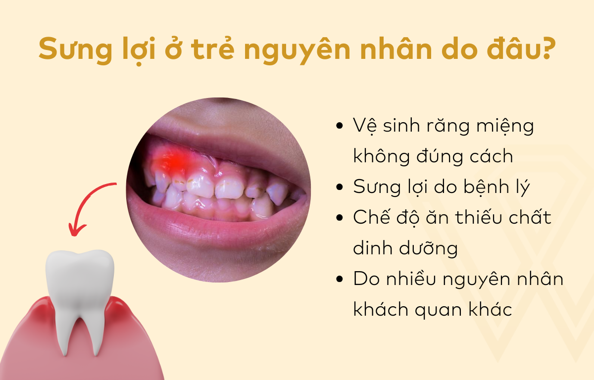 Sưng lợi ở trẻ nguyên nhân do đâu