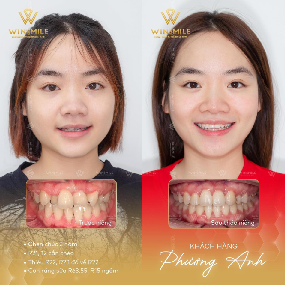 Ca niềng thành công của bác sĩ Hứa Thị Xuân