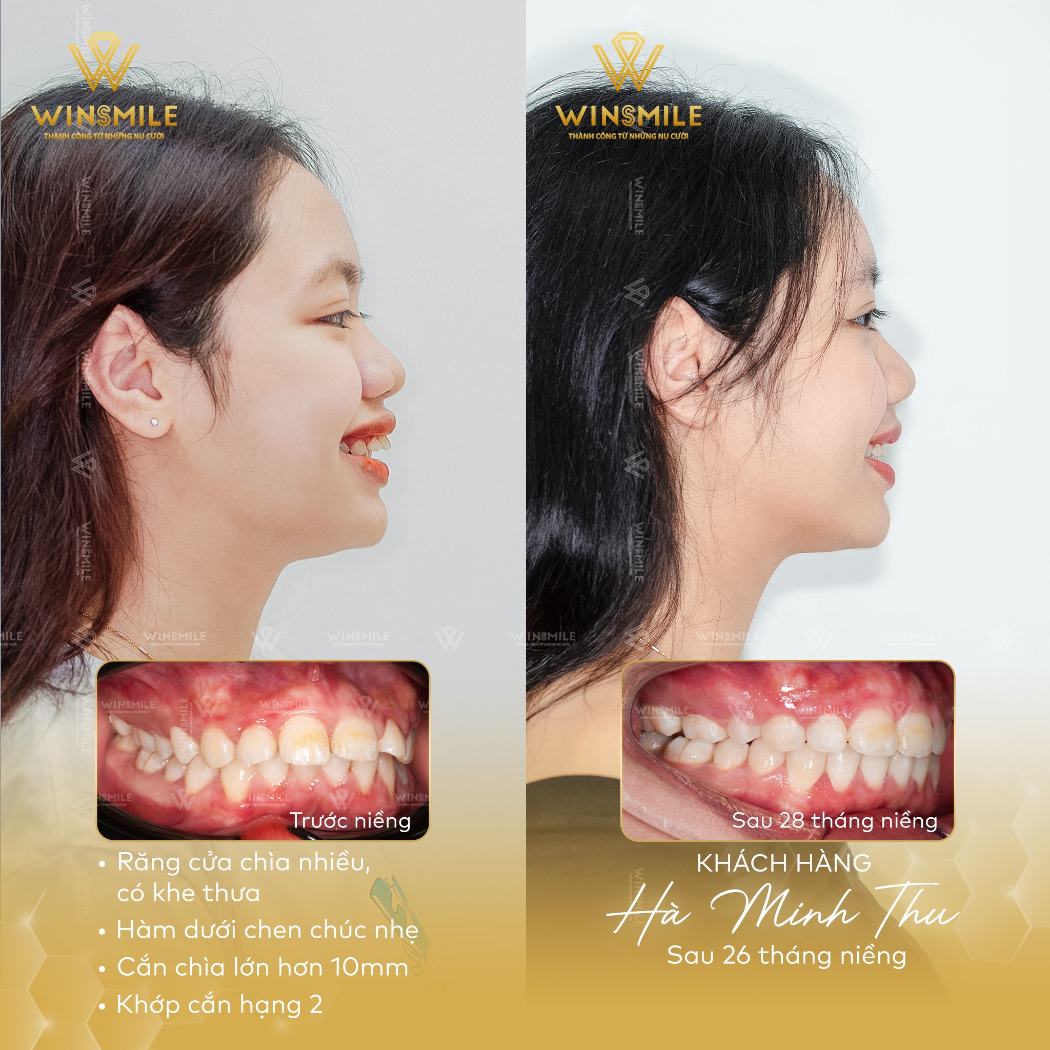 Ca niềng thành công của bác sĩ Hứa Thị Xuân