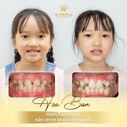 Các trường hợp niềng răng sớm cho trẻ tại nha khoa Win Smile