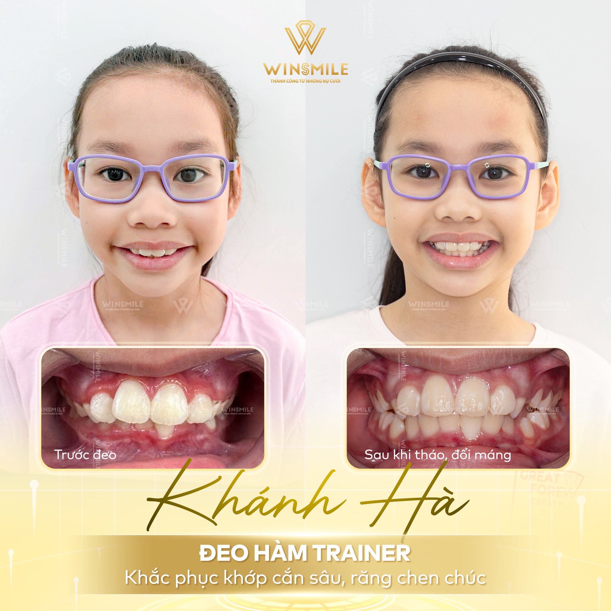 Các trường hợp niềng răng sớm cho trẻ tại nha khoa Win Smile