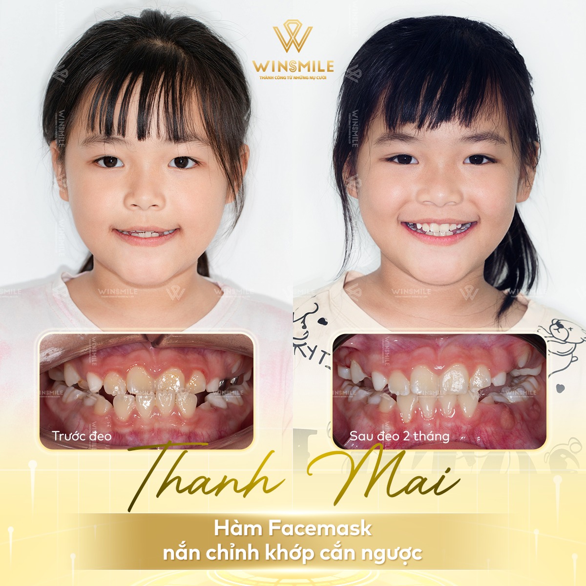 Các trường hợp niềng răng sớm cho trẻ tại nha khoa Win Smile