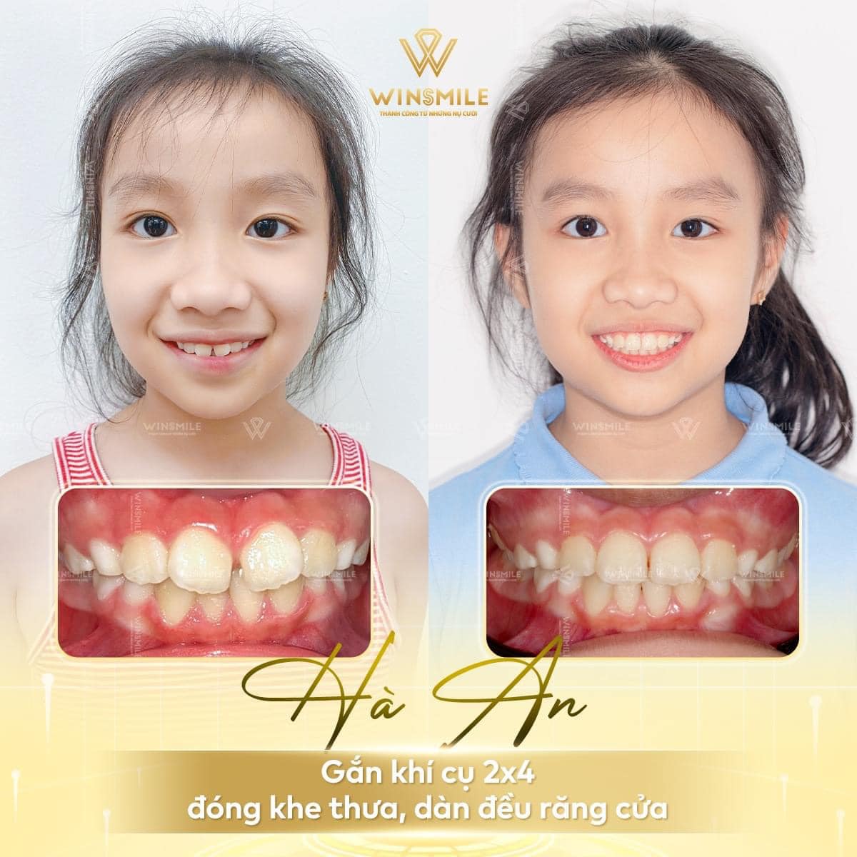 Các trường hợp niềng răng sớm cho trẻ tại nha khoa Win Smile