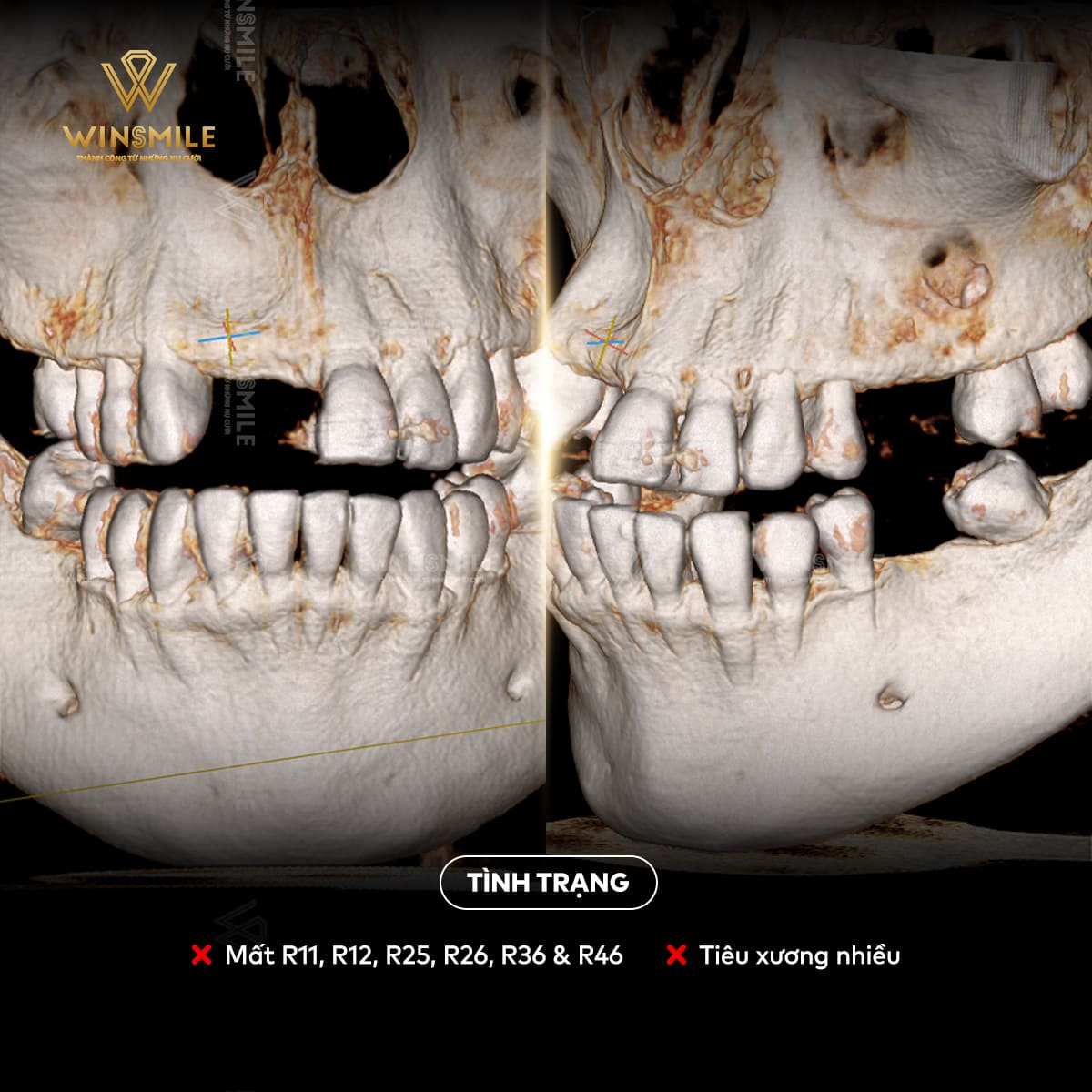 Mất răng lâu năm khiến răng xô lệch, tiêu xương hàm