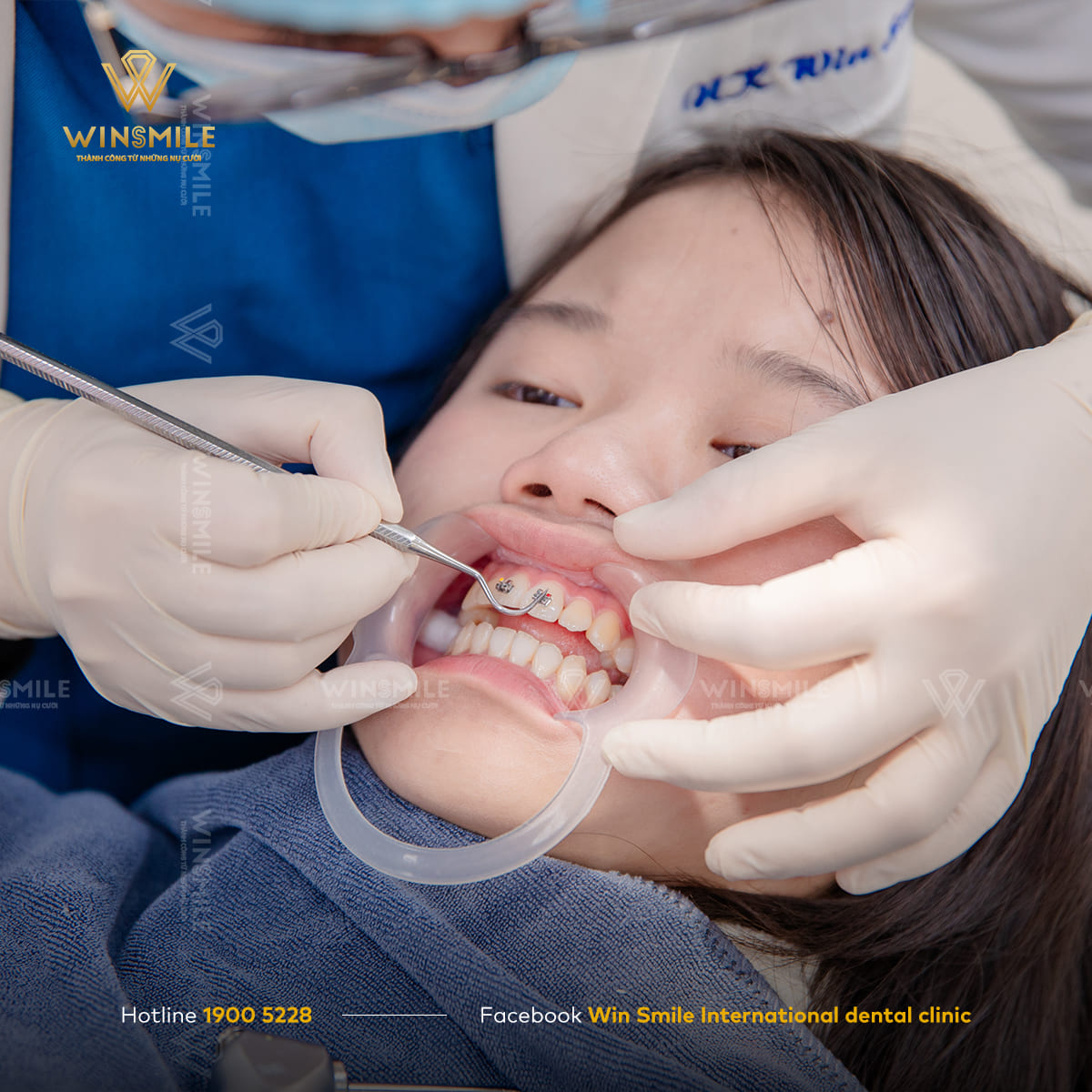 Niềng răng mắc cài áp dụng được với tất cả các ca chỉnh nha từ nhẹ đến phức tạp