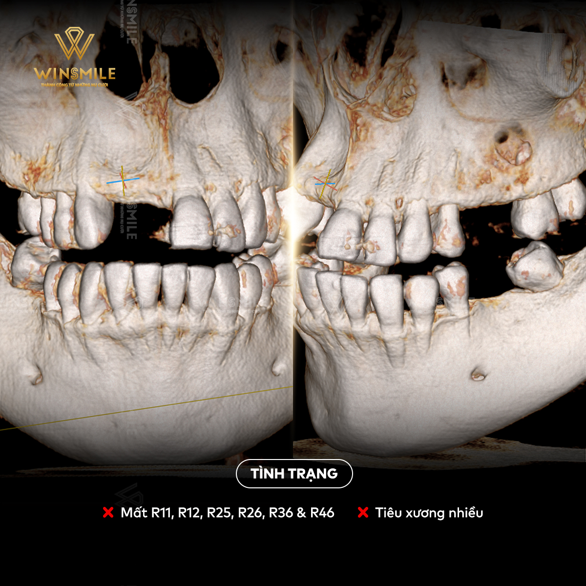 Bác sĩ nha khoa kiểm tra tình trạng xương hàm ngay tại vị trí cần trồng Implant