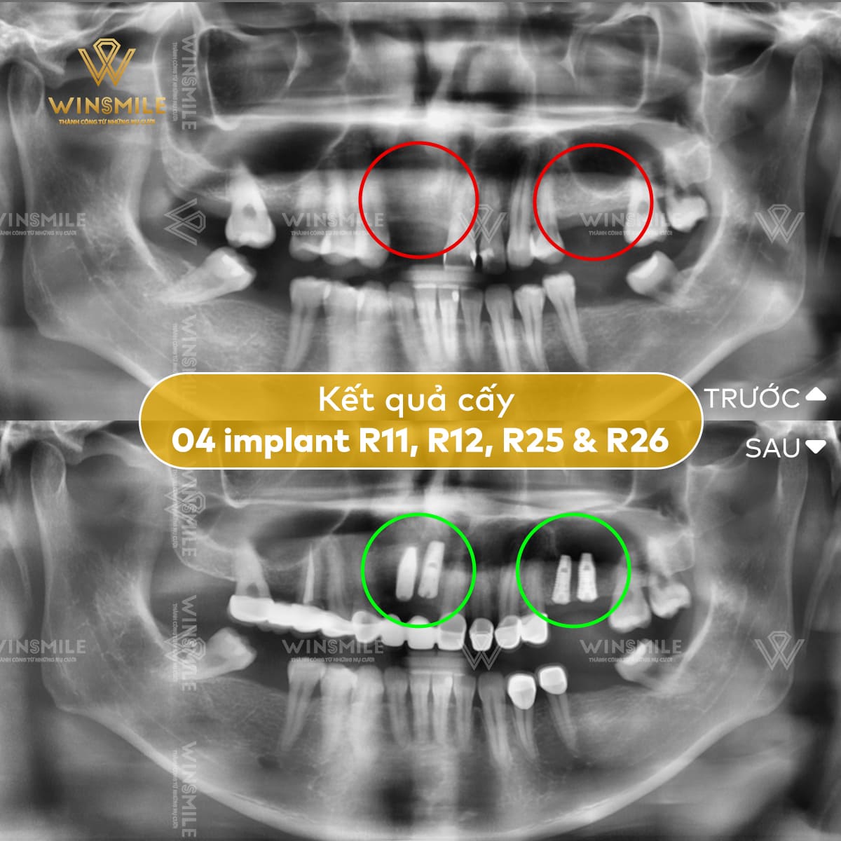 Trồng Implant thay thế những răng đã mất - Phục hồi chức năng ăn nhai và thẩm mỹ