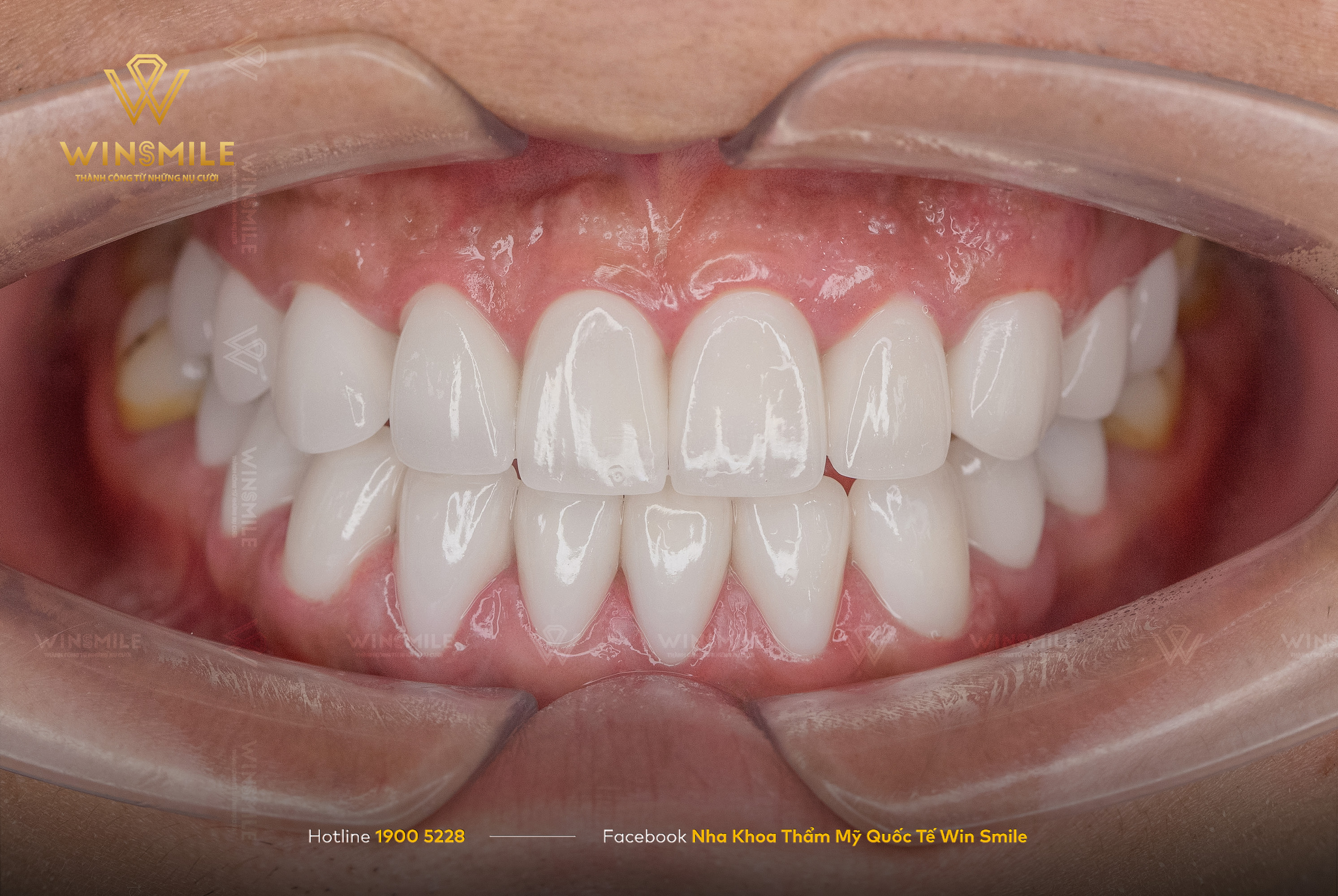 Bọc răng sứ Ceramill giúp cải thiện triệt để tình trạng răng ban đầu