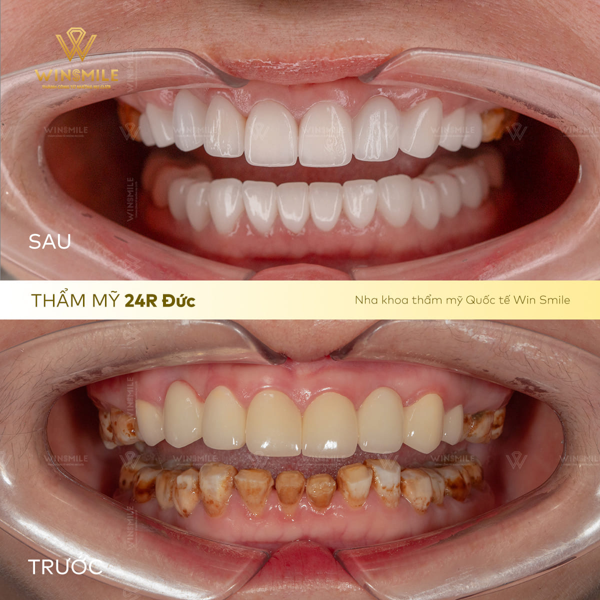 Tình trạng răng sứ hỏng mòn, đục kém thẩm mỹ