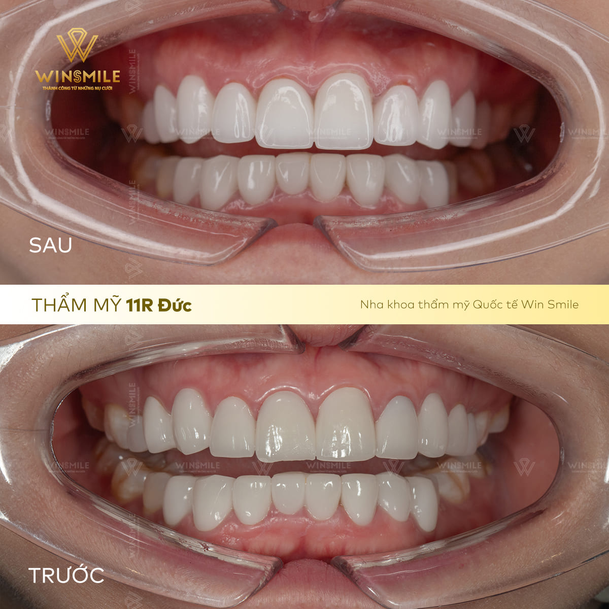 Nâng tầm thẩm mỹ cho nụ cười răng sứ tinh tế, rạng ngời hơn