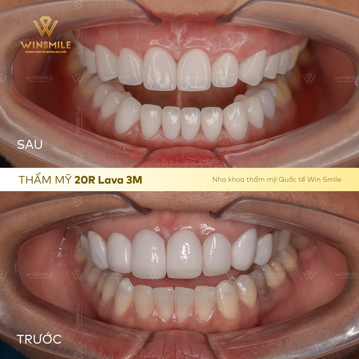 Răng sứ chất lượng cho nụ cười mới thẩm mỹ hoàn hảo