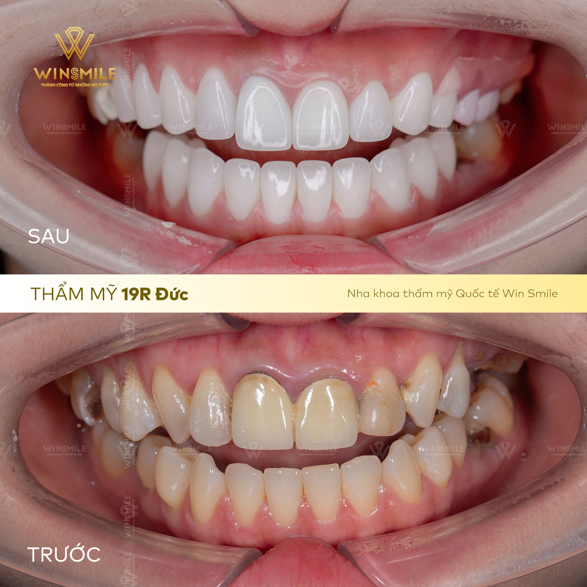 Răng sứ hỏng, xỉn màu, đen viền nướu