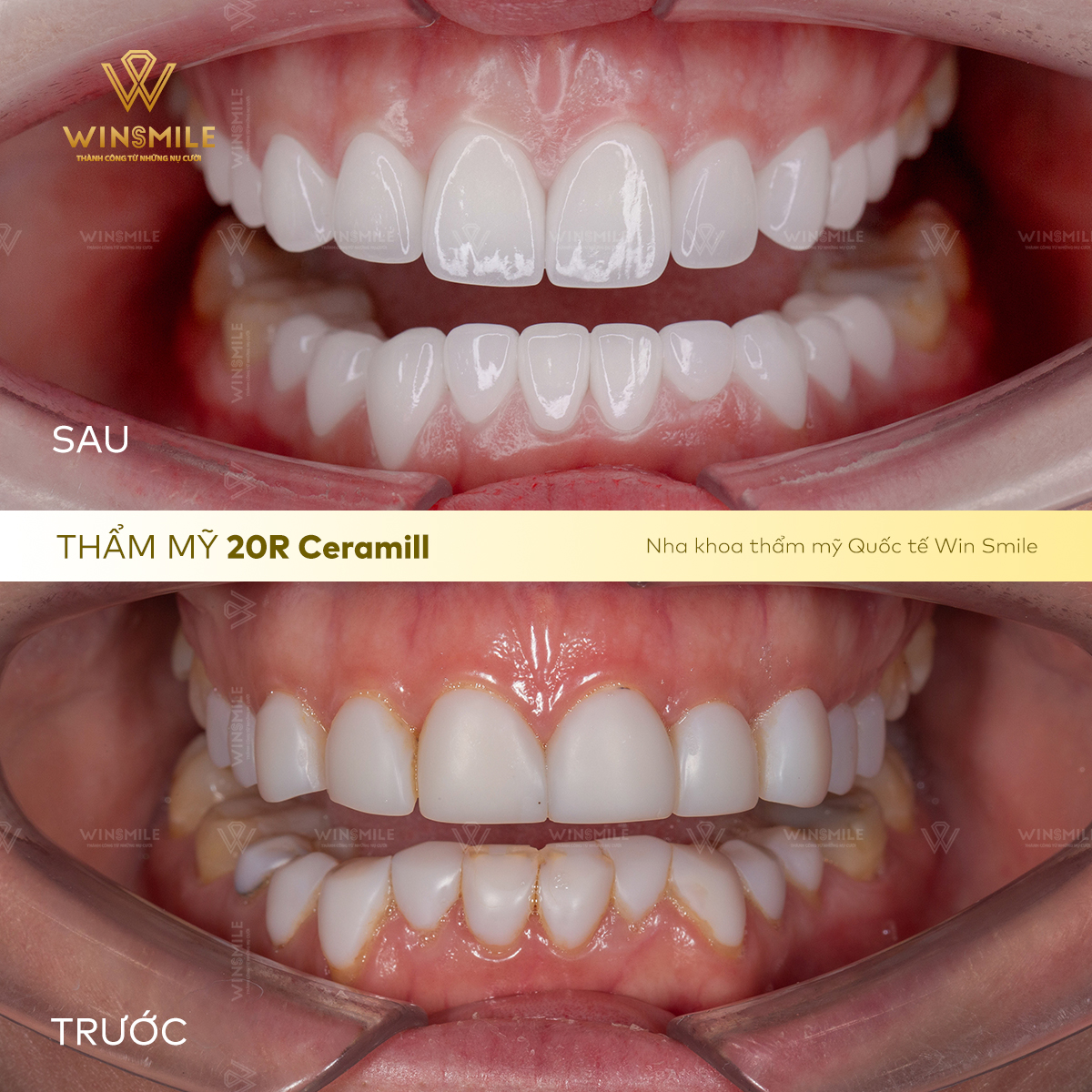 Chất lượng sứ không đảm bảo khiến màu răng đục, kém tự nhiên