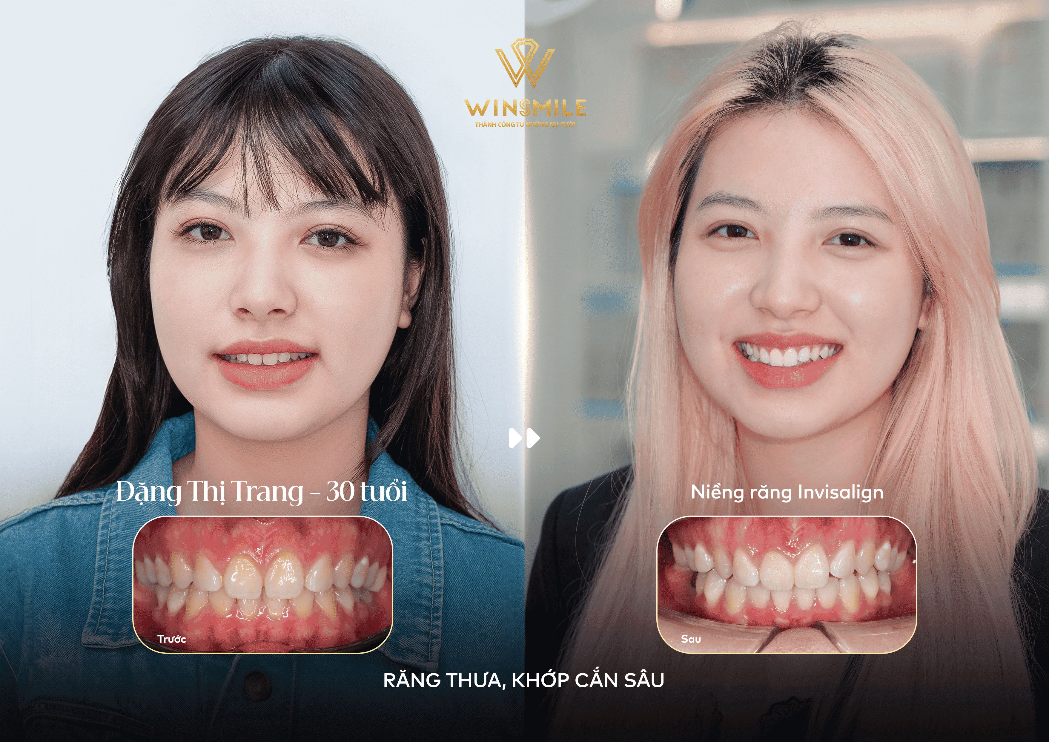 Khách hàng răng thưa, khớp cắn sâu phù hợp với phương pháp niềng răng trong suốt