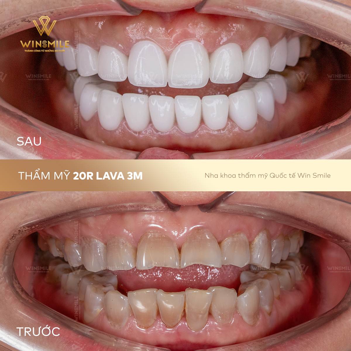 Bọc sứ thẩm mỹ - Tái sinh nụ cười nhiễm Tetracycline