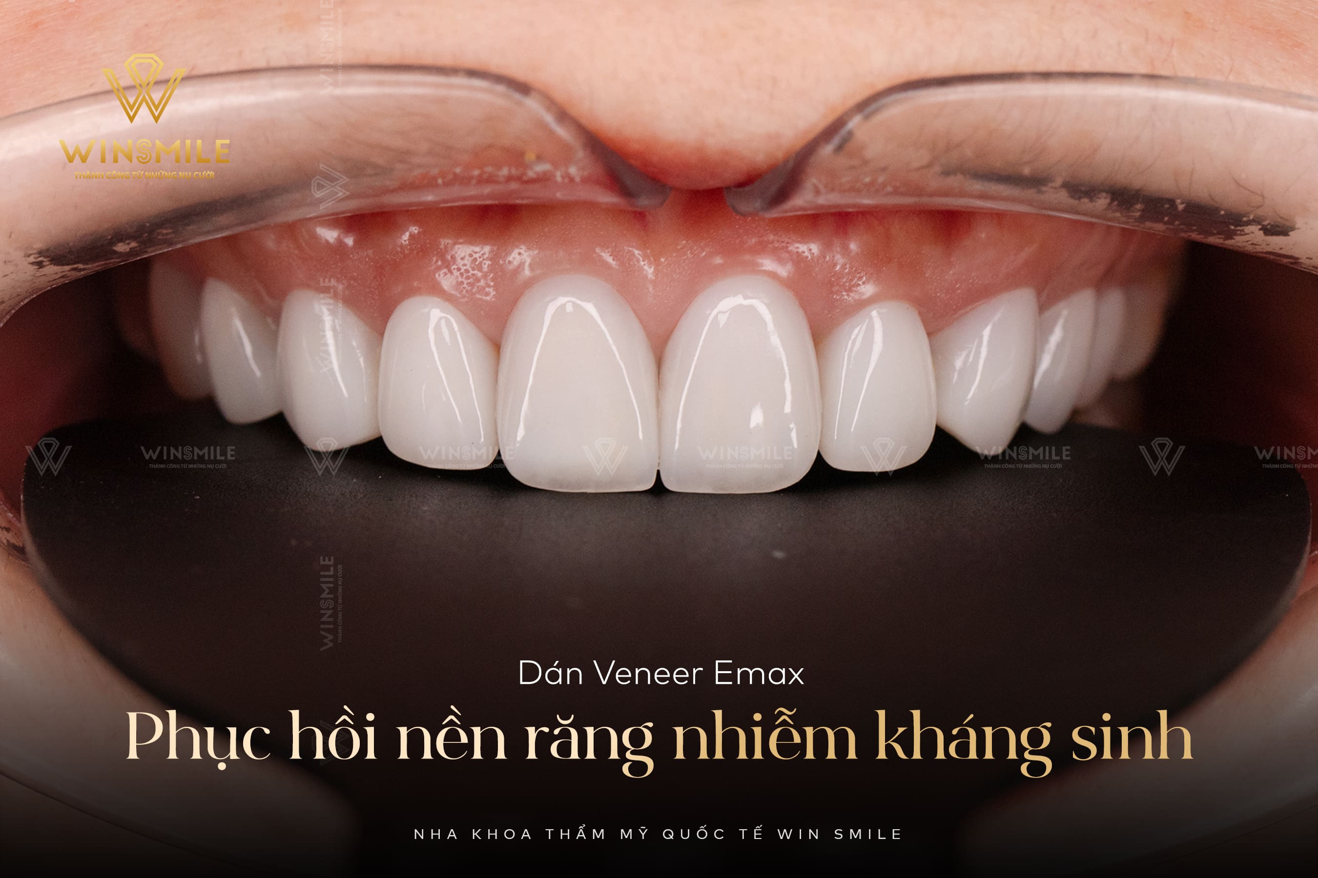 Dán sứ Veneer Emax với form răng Oval thanh thoát, mềm mại