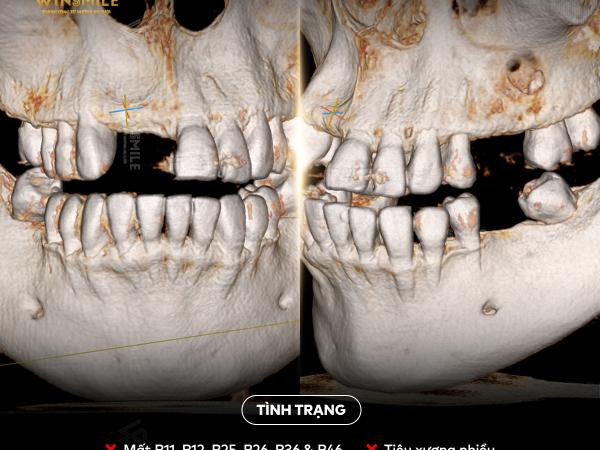 Bị loãng xương có trồng Implant được không?