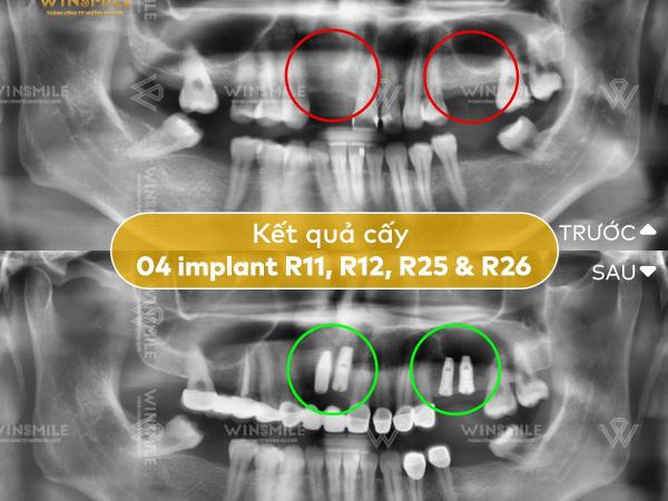 Mất răng lâu năm có trồng Implant được không? Cảnh báo biến chứng tiêu xương hàm
