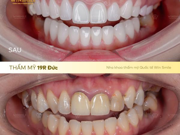 Nhận biết răng sứ hỏng: Dấu hiệu, hậu quả và giải pháp khắc phục