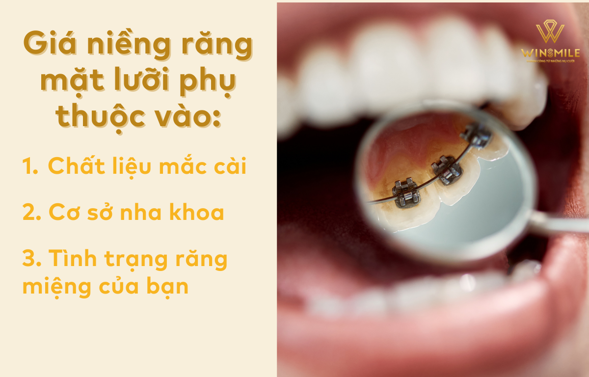 Giá niềng răng mắc cài mặt lưỡi phụ thuộc vào yếu tố nào