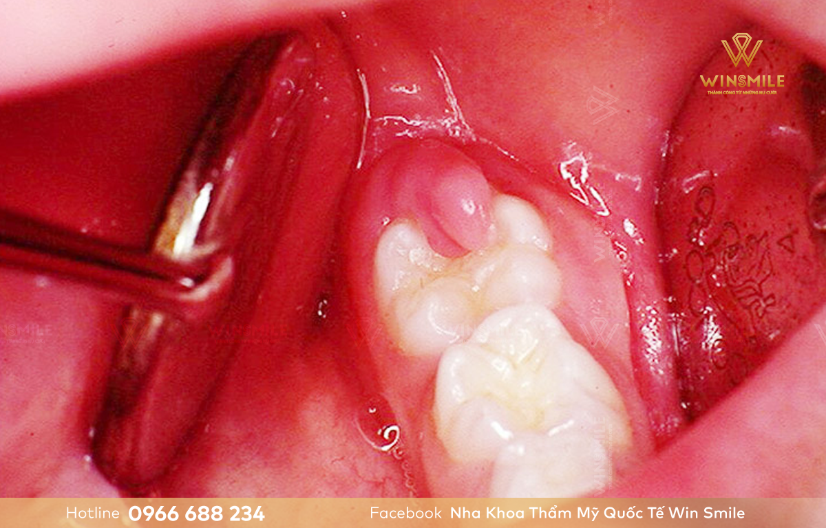 Sưng nướu răng khôn cần được khắc phục sớm để tránh gây đau nhức, khó chịu