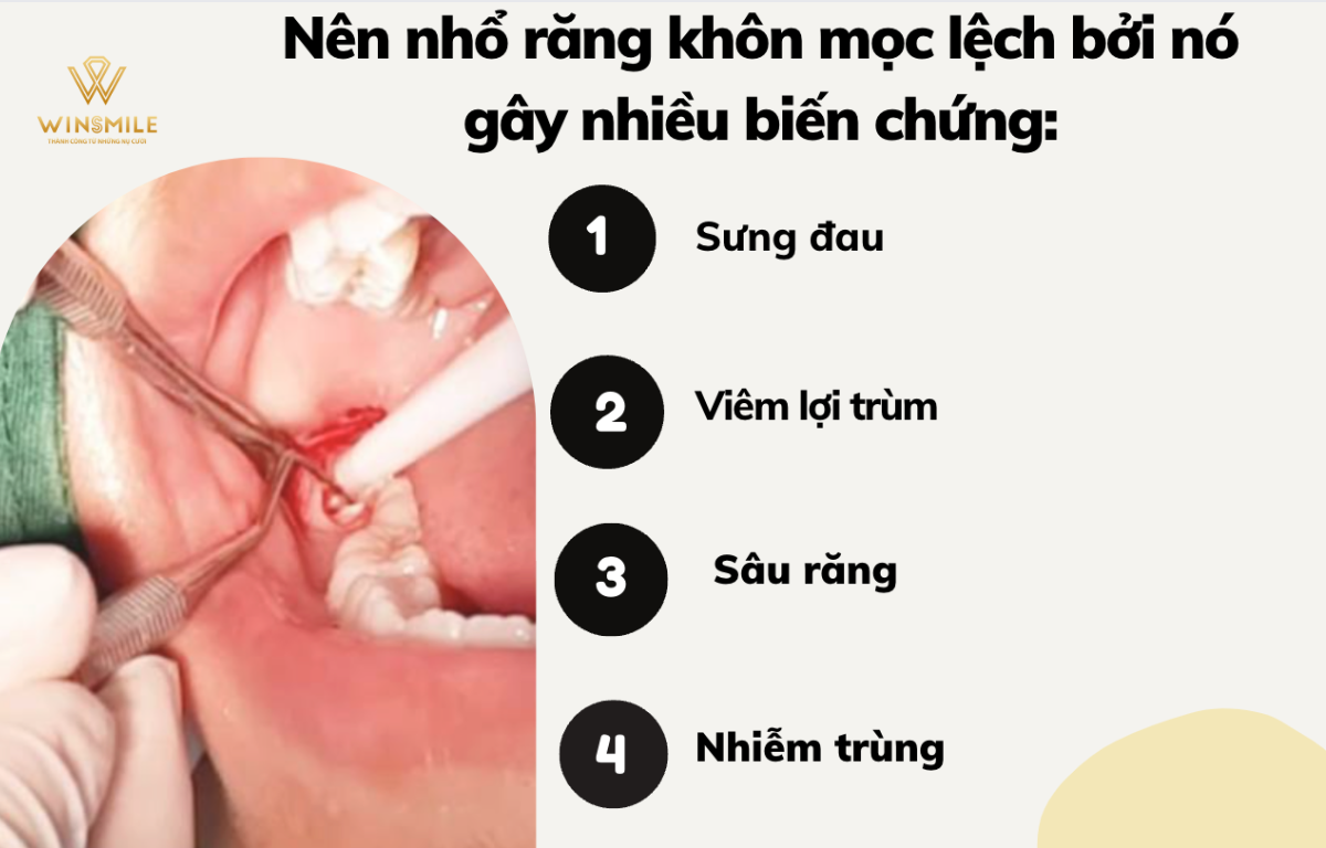 Răng khôn mọc lệch nếu không nhổ sẽ gây nên nhiều biến chứng